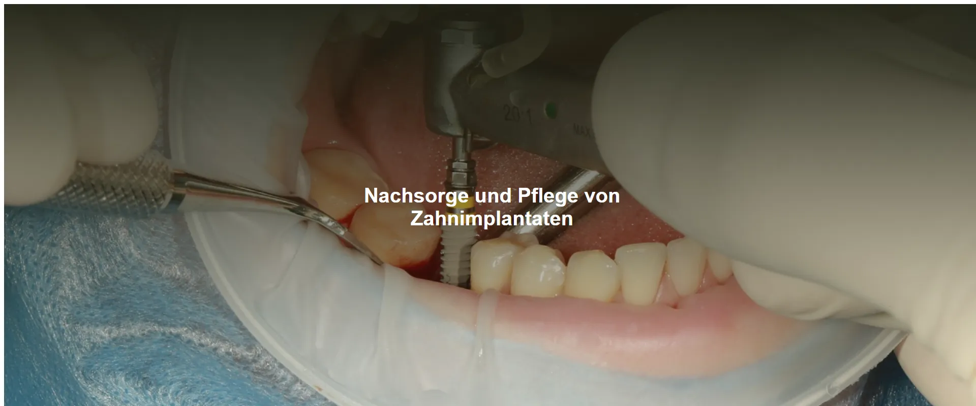 Nachsorge und Pflege von Zahnimplantaten